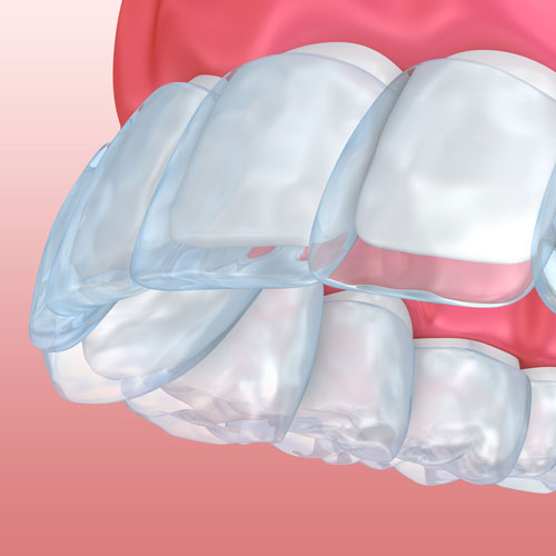 Illustration of Invisalign tray